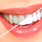 11 Natural ways to whiten your teeth