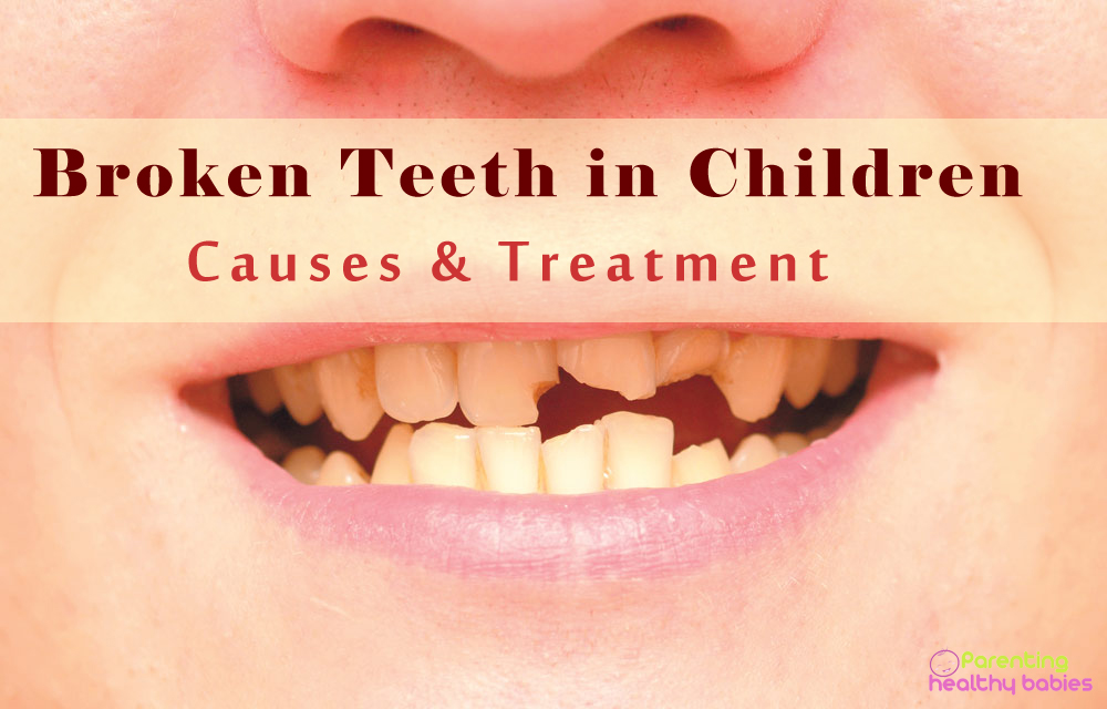 broken teeth in children