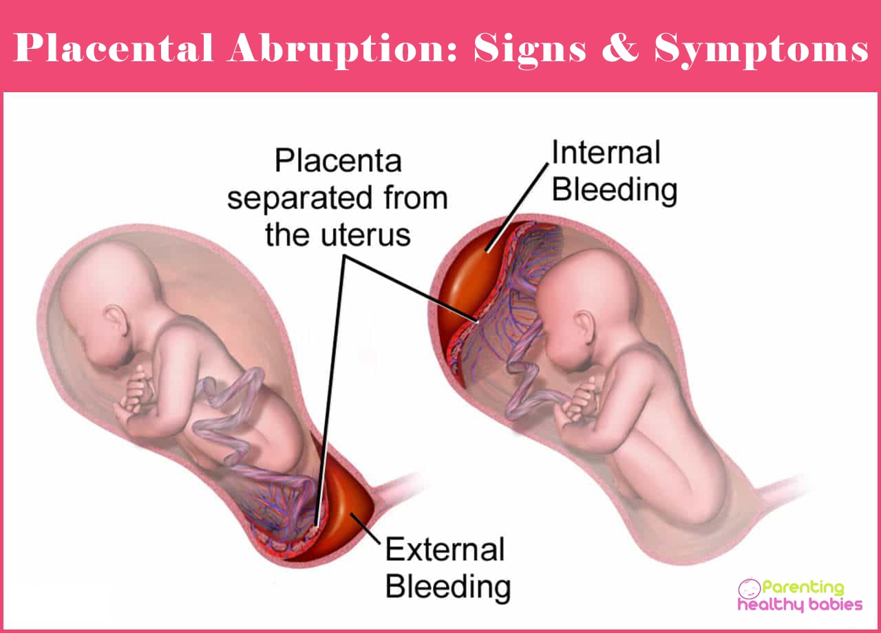 placental abruption