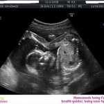 WEEK 31 OF PREGNANCY – PREGNANCY WEEK BY WEEK