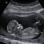 Ultrasound At 12 Weeks – All You Need To Know