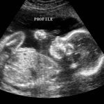 week 38 pregnancy ultrasound