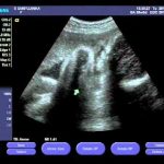 week 39 pregnancy ultrasound