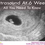 Ultrasound At 6 Weeks – All You Need To Know