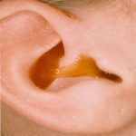 How to Get Water Out Of Your Child’s Ear