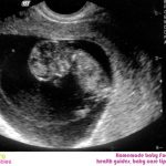 Ultrasound At 10 Weeks – All You Need To Know