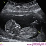 Ultrasound At 12 Weeks – All You Need To Know