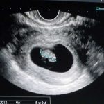 Ultrasound At 8 Weeks – All You Need To Know
