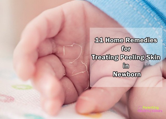 baby peeling skin remedies