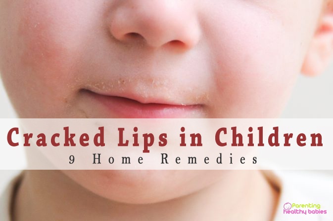 cracked lips in children