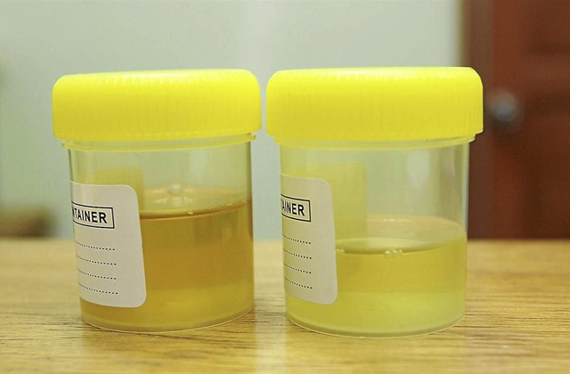 protein in urine during pregnancy