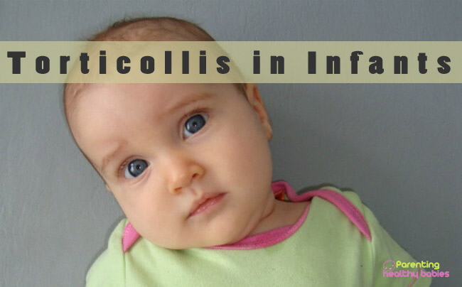 torticollis in infants