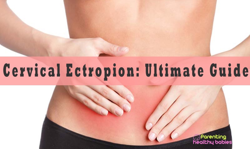 ultimate guide for cervical ectropion