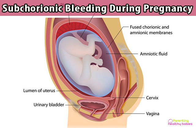 Subchorionic Bleeding During Pregnancy