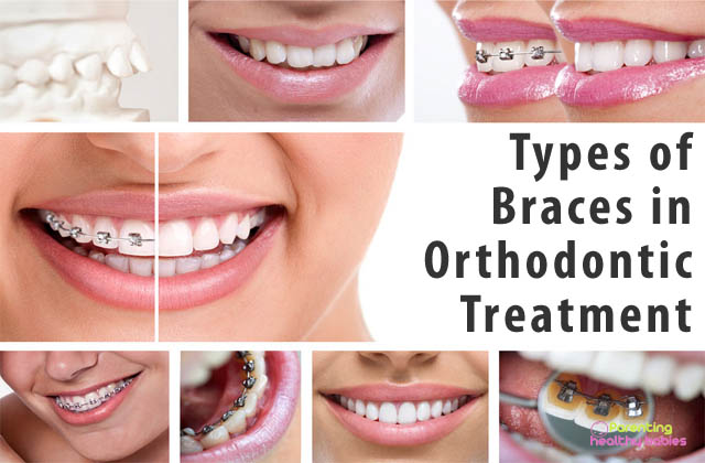 types of braces in orthodontic treatment