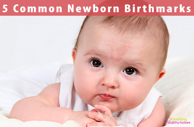 Common Newborn Birthmarks