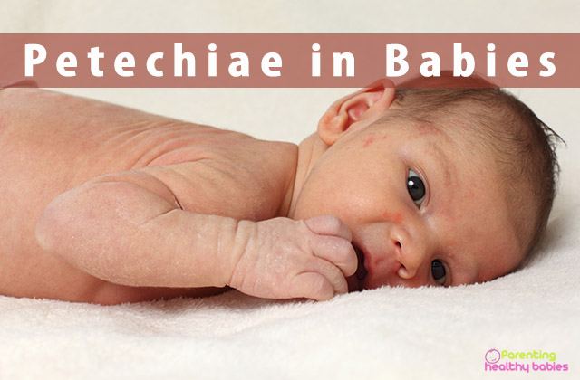 petechiae in babies