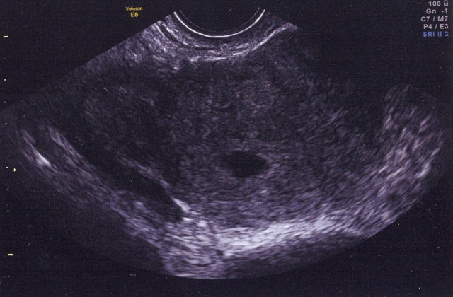 5 week ultrasound