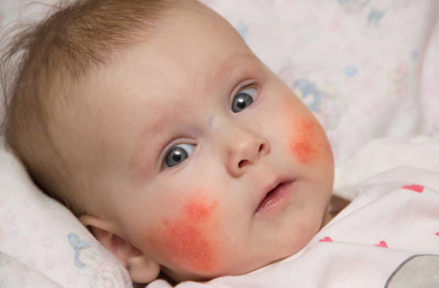 psoriasis in children