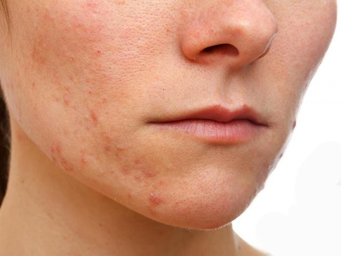 eczema on face