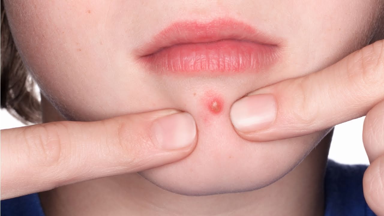 blackheads on chin