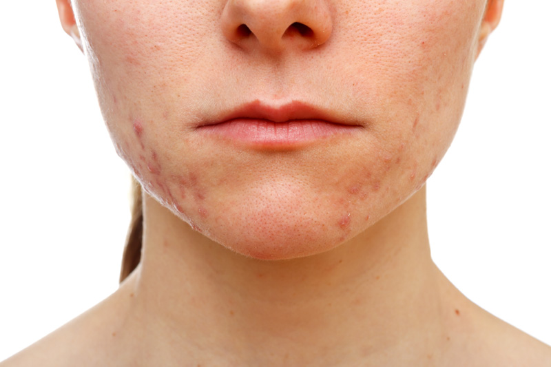 cystic acne