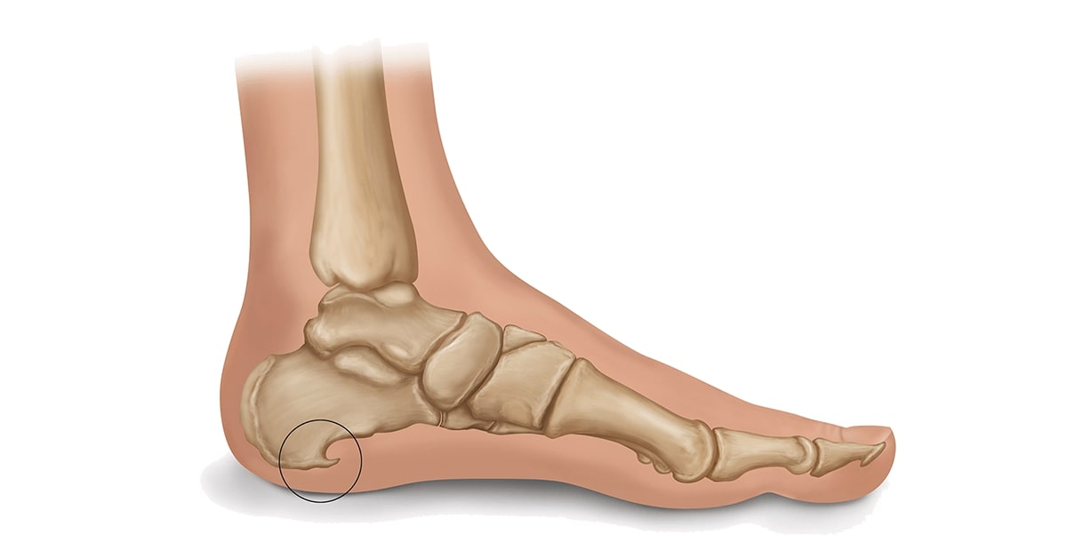 heel spur