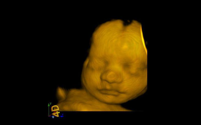 3d baby ultrasound