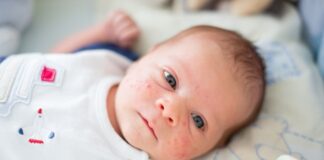 baby acne on face remedies