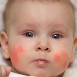 baby acne on face