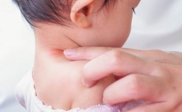 baby neck rash