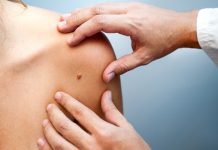 skin cancer