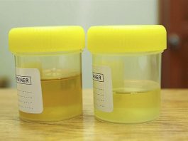 cloudy pee pregnancy