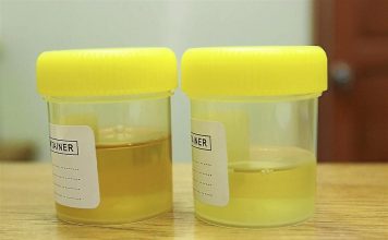 cloudy pee pregnancy