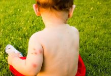 flea bites on babies