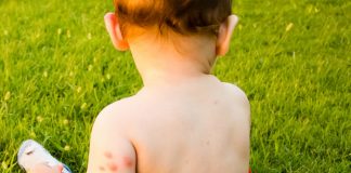 flea bites on babies