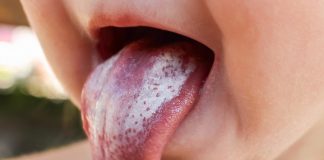 oral thrush in babies