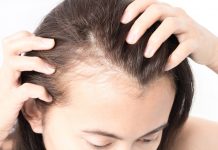 postpartum hair loss