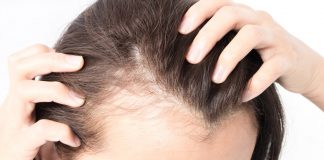 postpartum hair loss