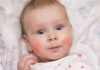 infant rash on face