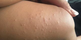 molluscum contagiosum treatment in children