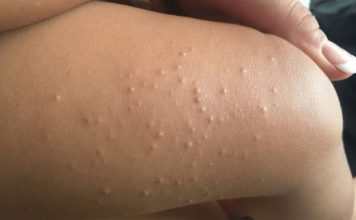 molluscum contagiosum treatment in children