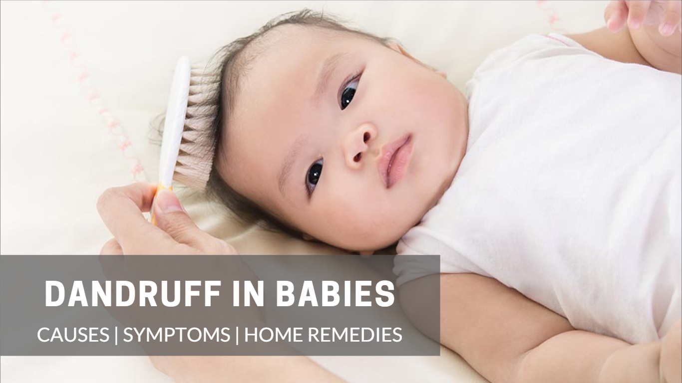Dandruff in Babies Causes, Symptoms and Home Remedies