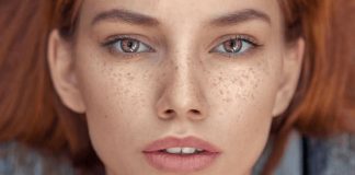 how to get rid of freckles