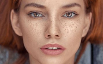 how to get rid of freckles