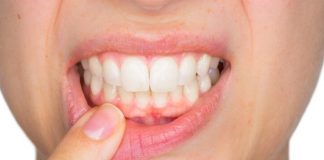 pregnancy gingivitis treatment