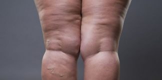 cellulitis in women