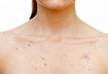 Pimples on Breasts