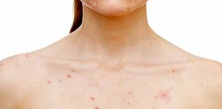 Pimples on Breasts