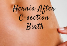 Hernia after C-Section